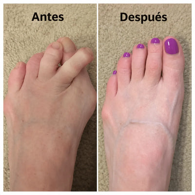 Élance™ Corrector de Juanetes