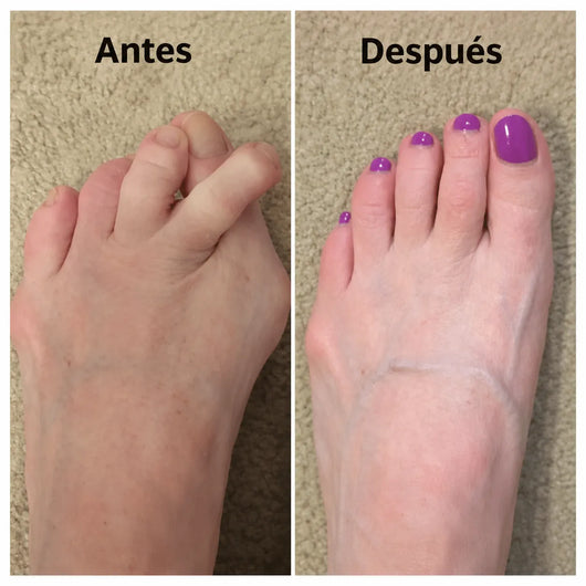 Élance™ Corrector de Juanetes