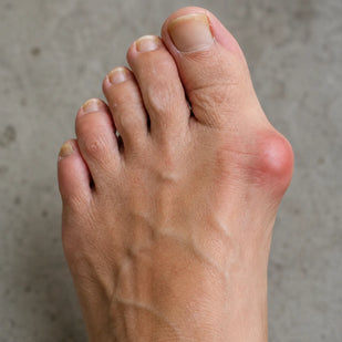 Joanete (Hallux Valgo)