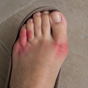 Dor ao Usar Sapatos