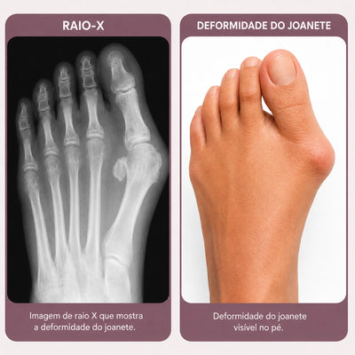 Élance™ – Corretor para Joanetes