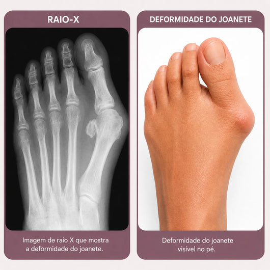 Élance™ – Corretor para Joanetes